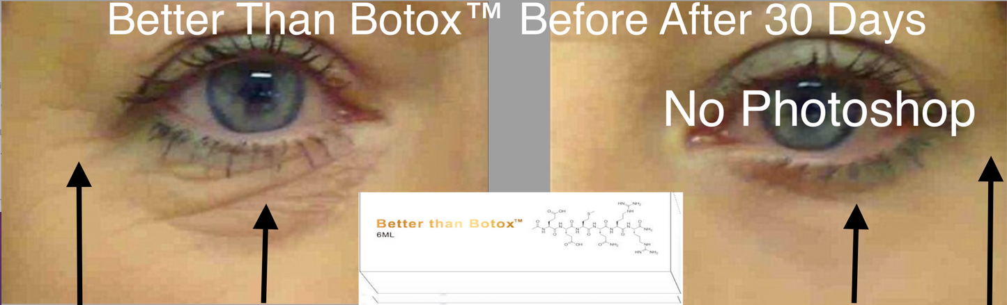 
                  
                    Mejor que Botox™ Arrugas debajo de los ojos
                  
                