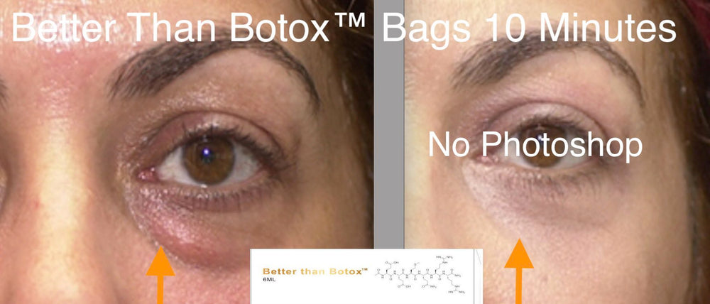 
                  
                    Mejor que Botox™ Arrugas debajo de los ojos
                  
                