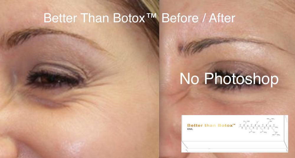 
                  
                    Mejor que Botox™ Arrugas debajo de los ojos
                  
                