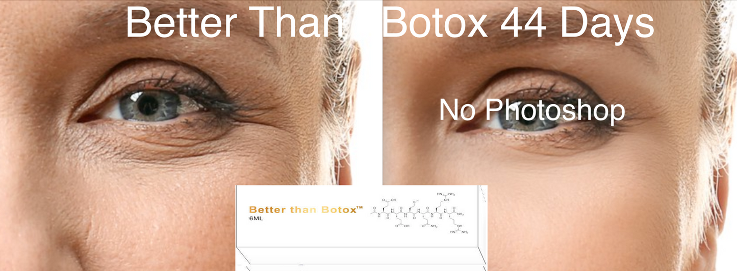 
                  
                    Mejor que Botox™ Arrugas debajo de los ojos
                  
                