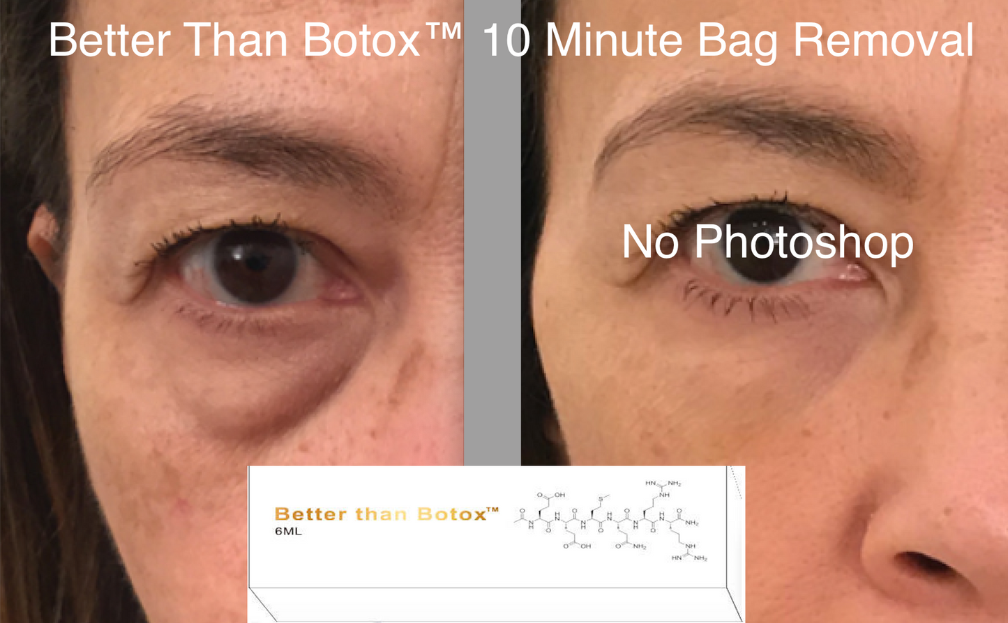 
                  
                    Mejor que Botox™ Arrugas debajo de los ojos
                  
                