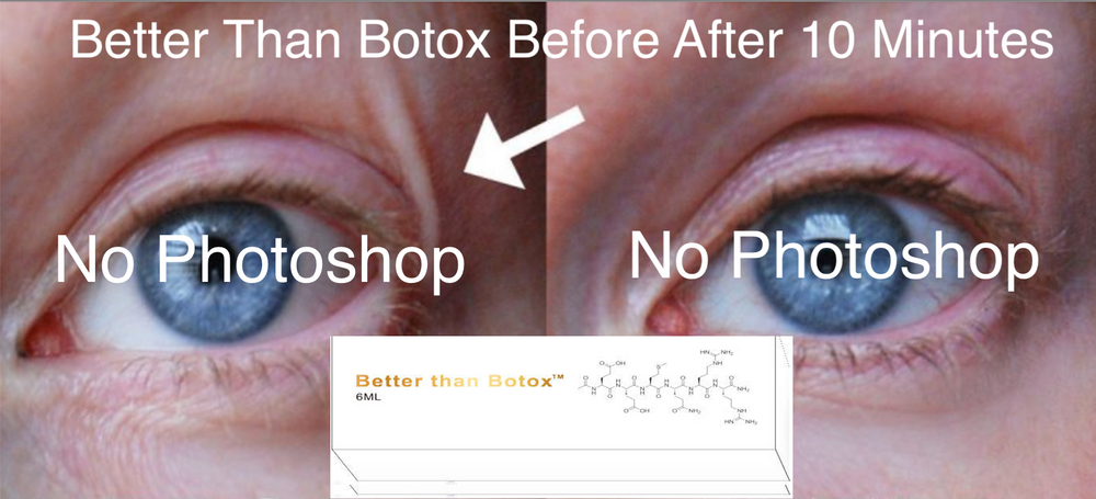 
                  
                    Mejor que Botox™ Arrugas debajo de los ojos
                  
                