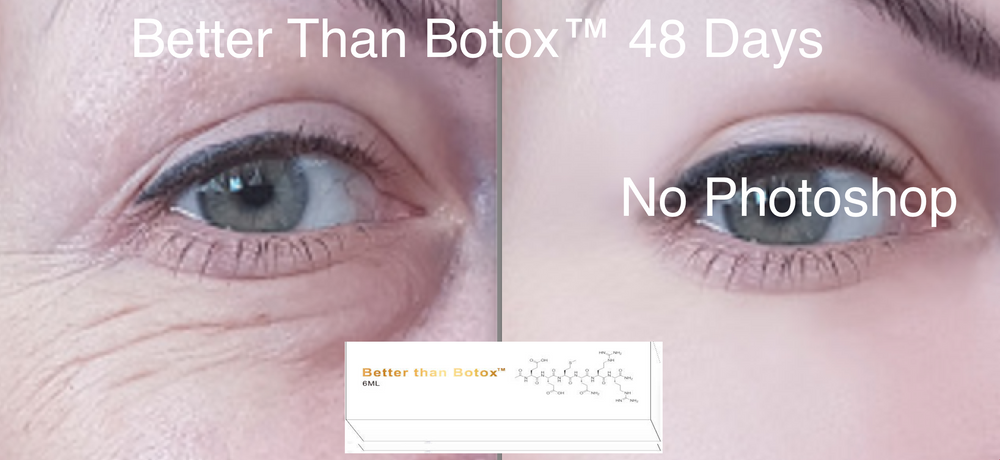 
                  
                    Mejor que Botox™ Arrugas debajo de los ojos
                  
                