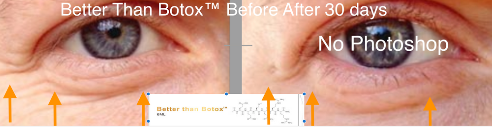 
                  
                    Mejor que Botox™ Arrugas debajo de los ojos
                  
                